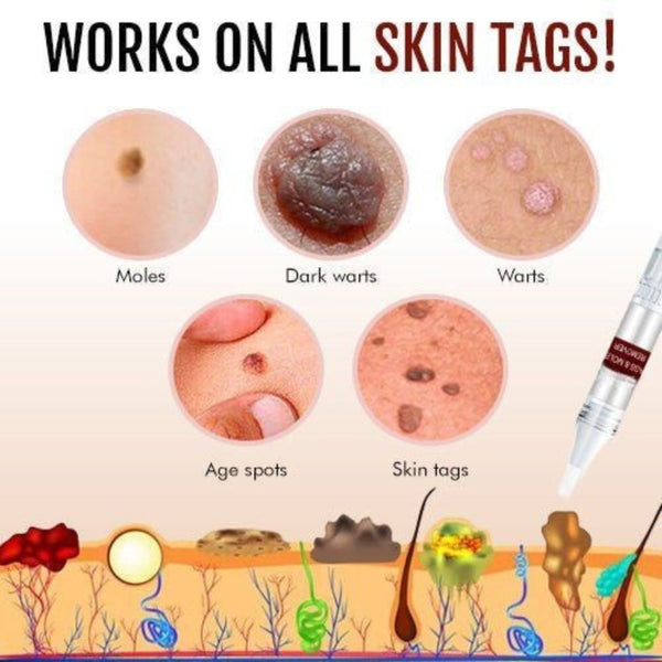 Tags & Moles Remover 1